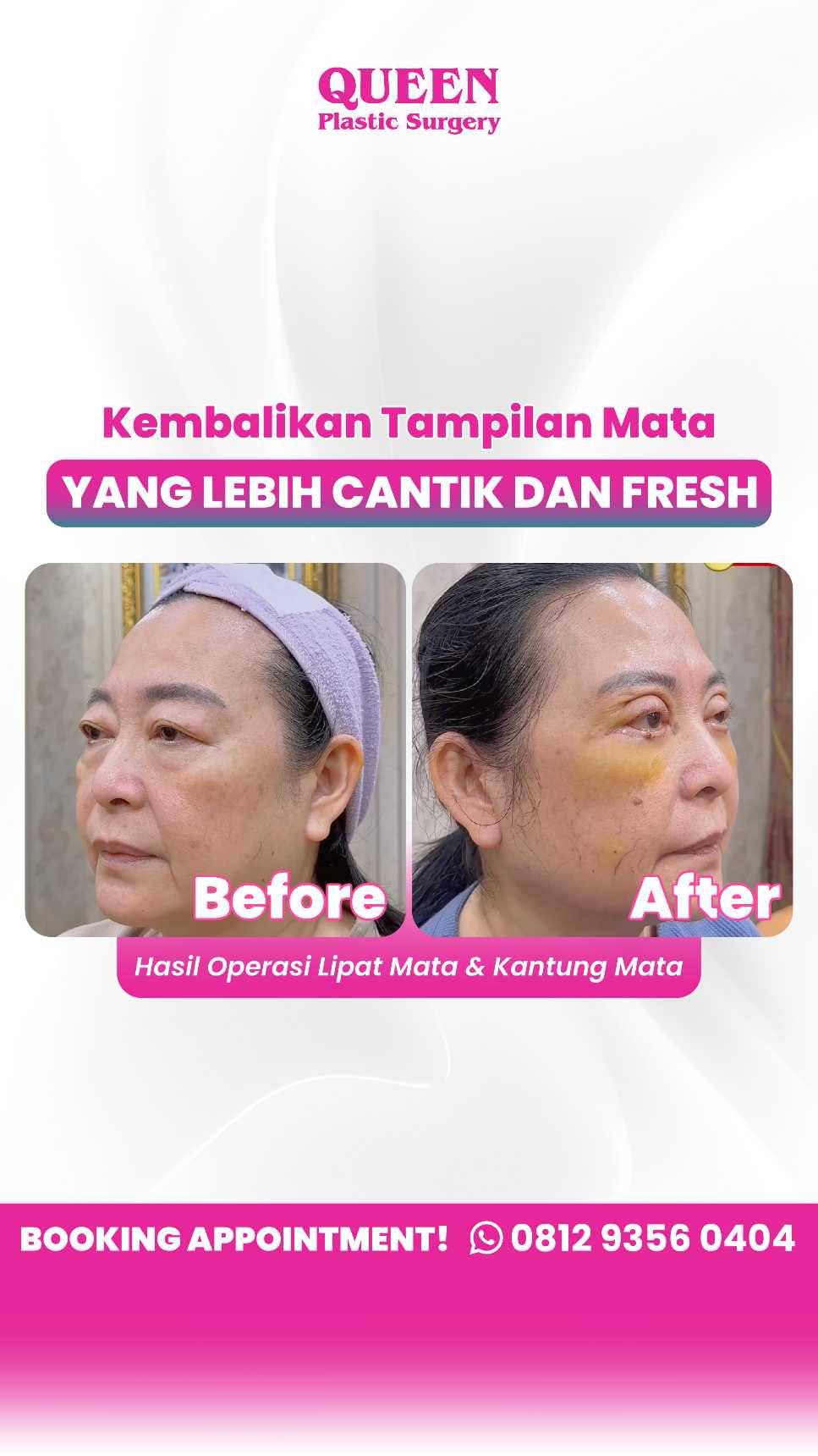 Bukan sekadar masalah kurang tidur! Simak alasan medis di balik kantung mata yang membandel.