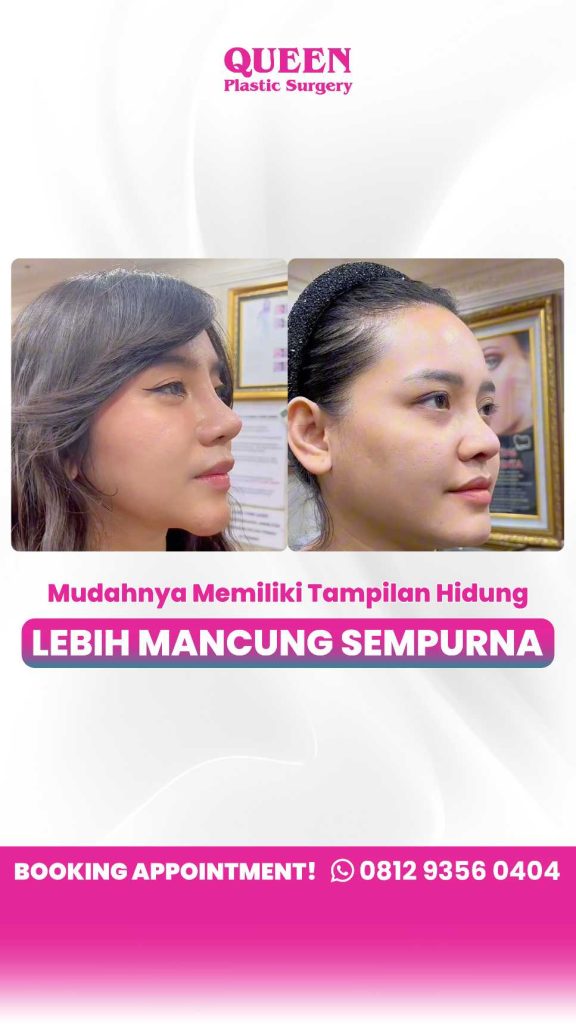 Tanpa drama bentuk hidung terlalu tajam atau kaku! 👋 Pelajari rahasia presisi Rhinoplasty dari Dr. Heri Noviana.