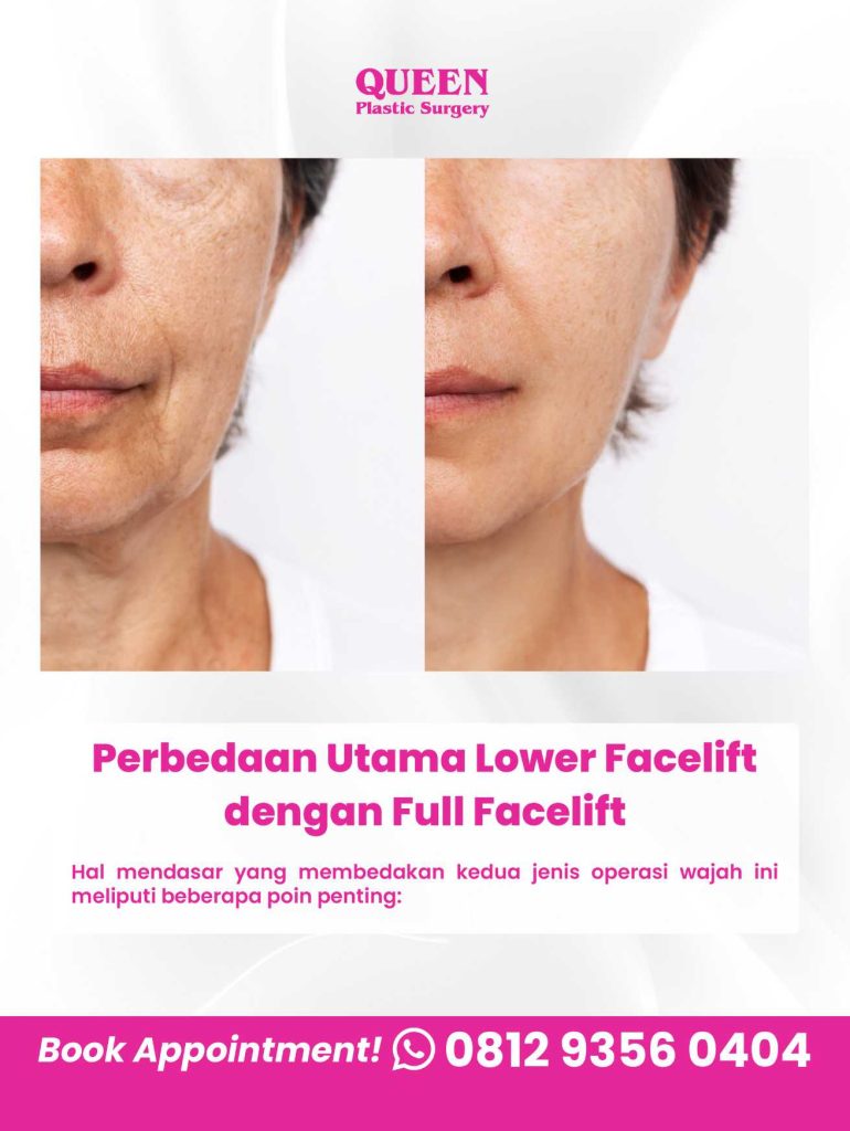 Bukan sekadar perawatan kulit biasa! Kenali prosedur Lower Facelift yang bisa membuang gelambir pipi bawah bersama Dr. Heri Noviana.