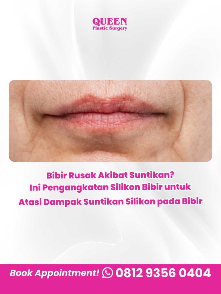 Bibir rusak akibat suntikan silikon? 👄 Hubungi Dr. Heri Noviana sekarang juga untuk konsultasi operasi pengangkatan dan perbaikan bibir.