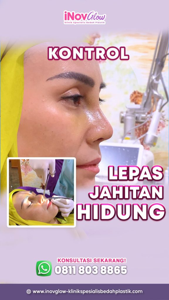 Rahasia pangkas waktu downtime operasi hidung lewat menu makanan meja makan Anda. ✨ Yuk, intip bocoran diet dari Dr. Heri Noviana!