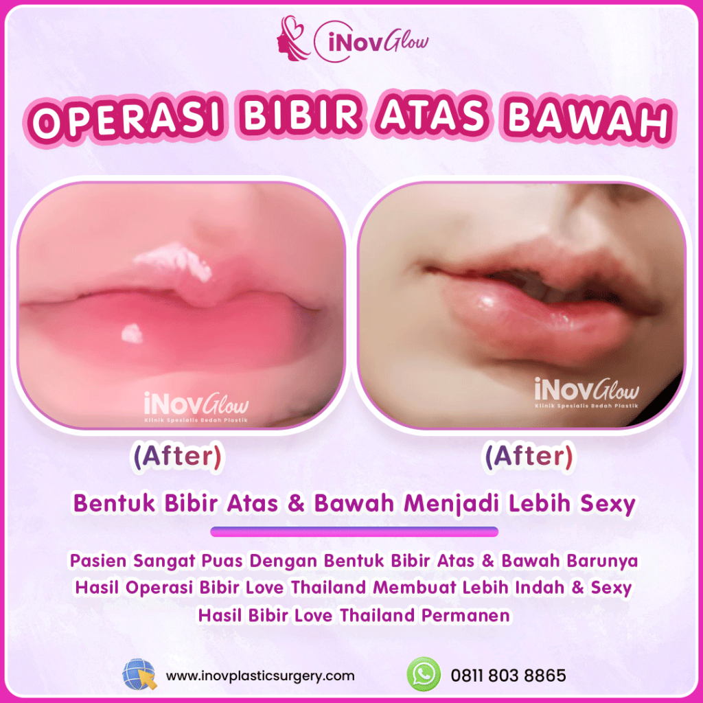 Bukan sulap! Cukup satu prosedur untuk miliki bibir seksi impian selamanya. 👄 Simak penjelasan detail Implan Bibir dari Dr. Heri Noviana.