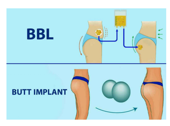 Bokong tepos vs bokong kendur akibat diet ekstrem? 🧐 Ketahui apakah Anda butuh Implan atau Pengencangan dari Dr. Heri Noviana!