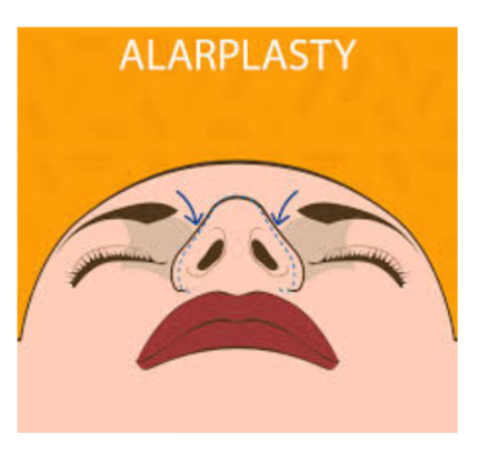 Bosan cuping hidung terlihat melebar saat bicara atau tertawa? 😰 Ketahui bagaimana Alarplasty mengubah penampilan Anda bersama Dr. Heri Noviana.