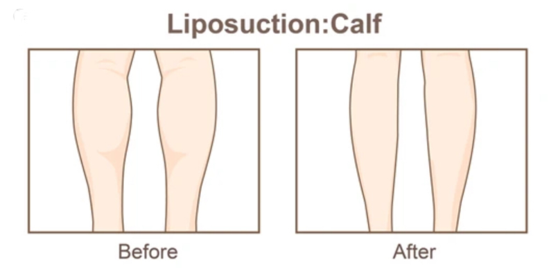 Sudah mati-matian olahraga tapi lemak di betis gak kunjung luntur? 🤔 Temukan keajaiban Liposuction betis bersama Dr. Heri Noviana di sini.