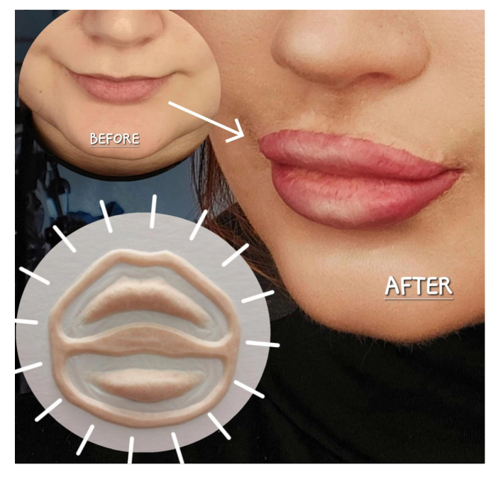 Bukan sulap! Prosedur medis Implan Bibir ini bisa bikin bibir Anda tampak penuh, sensual, dan natural seumur hidup. ✨ Simak ulasan Dr. Heri Noviana.