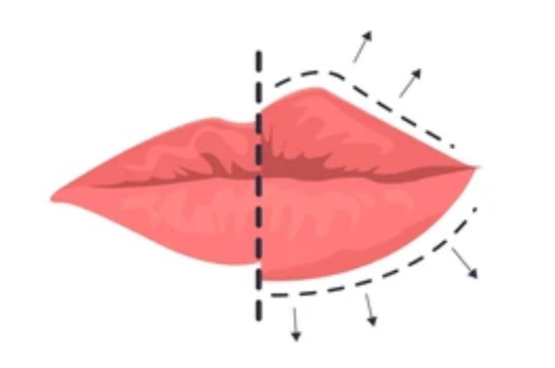 Bosan bolak-balik re-touch filler setiap beberapa bulan? 😰 Mungkin ini saatnya Anda beralih ke implan bibir bersama Dr. Heri Noviana.