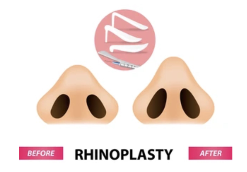 Penting! Memahami peran implan silikon dalam Rhinoplasty untuk hasil alami. 👃 Hubungi Dr. Heri Noviana sekarang untuk konsultasi hidung Anda.