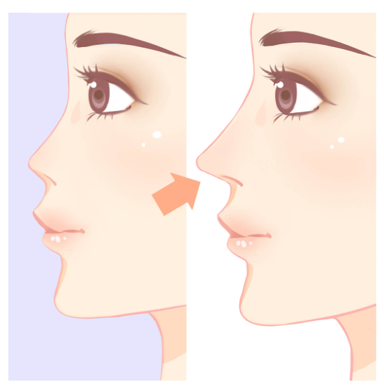 Operasi hidung ternyata bisa memberikan efek lifting alami pada seluruh area tengah wajah? 😱 Cek faktanya bersama Dr. Heri Noviana di artikel ini.