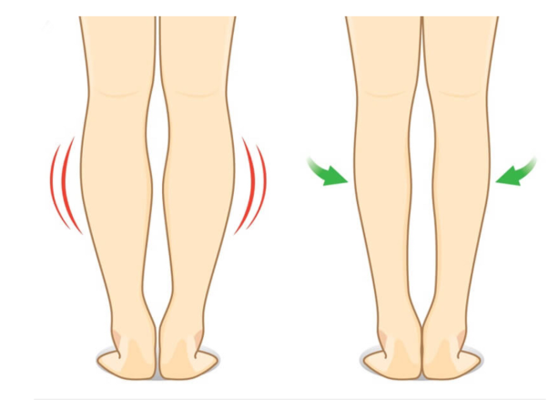 Otot betis besar dan keras bikin gak pede pakai rok mini? 🛑 Ini solusi medis Calf Reduction untuk kaki ramping dari Dr. Heri Noviana!