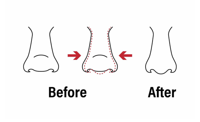 Miliki bentuk hidung ramping, proporsional, dan penuh percaya diri seumur hidup. 📈 Simak panduan lengkap Alarplasty bersama Dr. Heri Noviana hanya di sini!