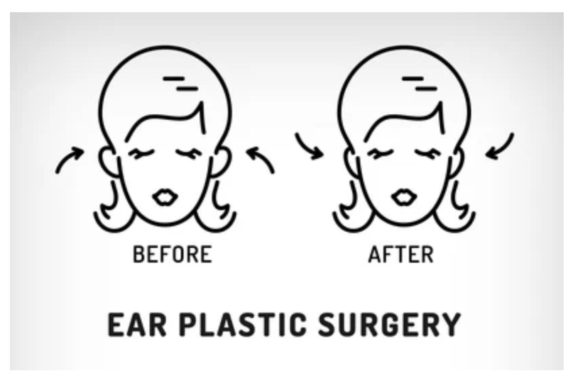 Banyak yang gak sadar, telinga caplang (prominent ears) ternyata bisa dikoreksi secara permanen dan aman. 😲 Intip penjelasannya dari Dr. Heri Noviana.