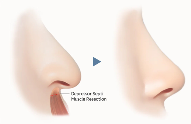 Jangan Panik! Ini Ulasan Rhinoplasty Gagal: Penyebab dan Cara Mengatasinya