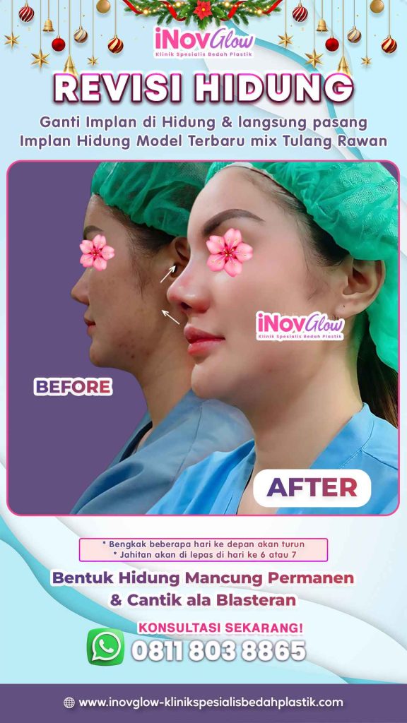 Rahasia menyelamatkan struktur hidung baru Anda dari kerusakan pasca-insiden benturan tidak terduga. ✨ Simak saran Dr. Heri Noviana!