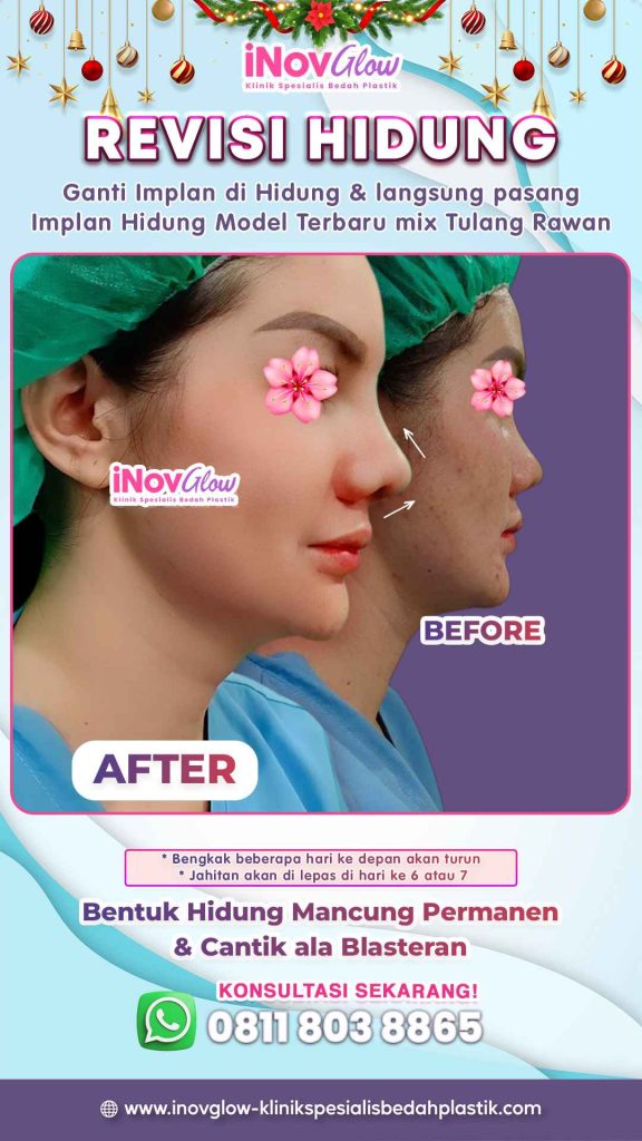Baru Rhinoplasty lalu tidak sengaja terbentur masker atau kacamata? 😰 Pahami bedanya benturan ringan vs fatal menurut Dr. Heri Noviana.