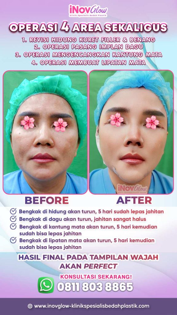 Dapatkan kepastian medis dan penanganan yang tepat untuk menjaga keindahan hidung idaman Anda. ✨ Hubungi Dr. Heri Noviana sekarang juga!
