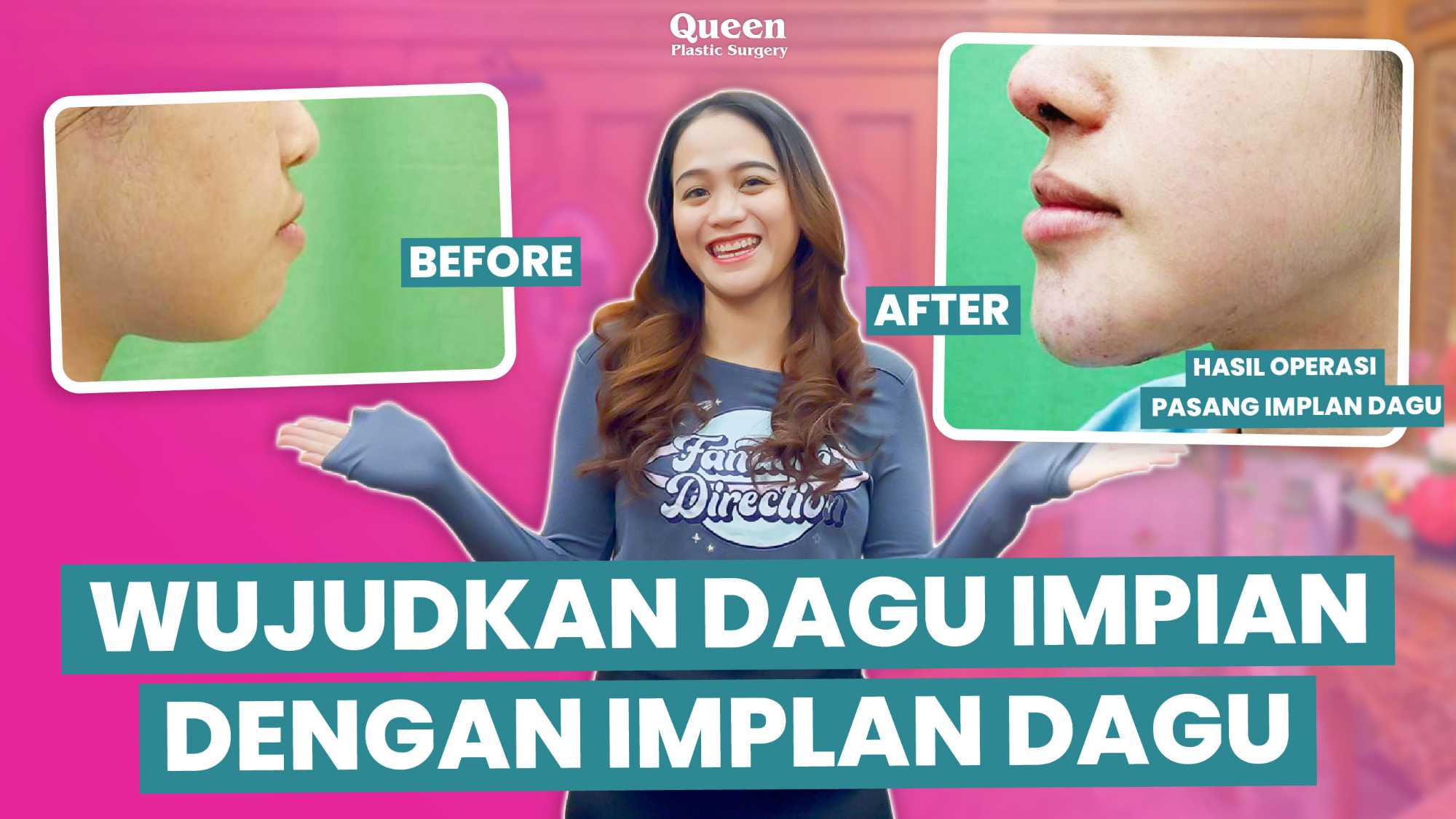 Dagu kelihatan 'mundur' atau kurang berdefinisi bikin wajah tampak bulat dan kurang proporsional? 😱 Cek rahasia solusinya dengan Genioplasti dari Dr. Heri Noviana!