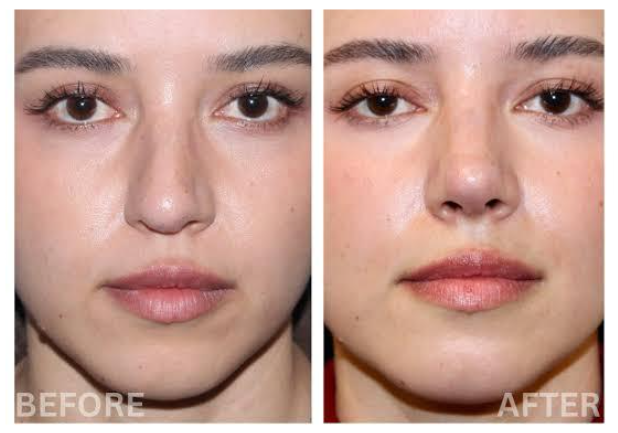 Bukan sekadar mancung atau tinggi! Ini alasan kenapa Rhinoplasty modern fokus pada keharmonisan seluruh sudut wajah Anda. Simak kata Dr. Heri Noviana.