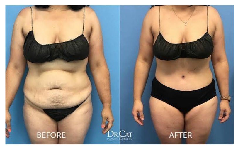 Bukan cuma lemak! Ini alasan kenapa olahraga sekeras apa pun gak akan bisa mengencangkan kulit perut yang sudah putus elastisitasnya. Simak kata Dr. Heri Noviana.