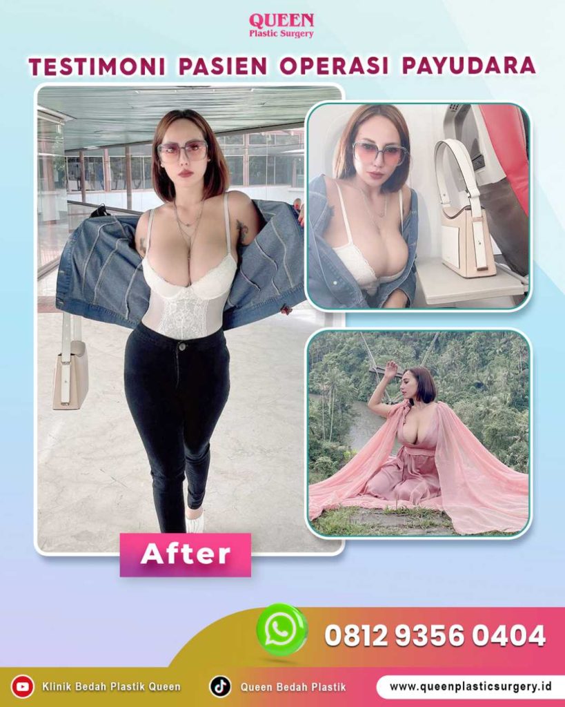 Rahasia mendapatkan bentuk dada berisi, proporsional, dan tetap terasa alami saat disentuh. ✨ Simak penjelasan Dr. Heri Noviana tentang Implan Payudara