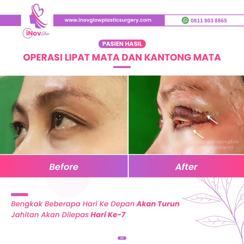 Kelopak Mata Turun Plus Alis Sagging? Ini Solusi Paling Ampuh Sebelum Nyesel! Cari tahu faktanya & konsultasi bareng Dr. Heri Noviana, Sp.BP-RE, M.Ked.Klin di sini!