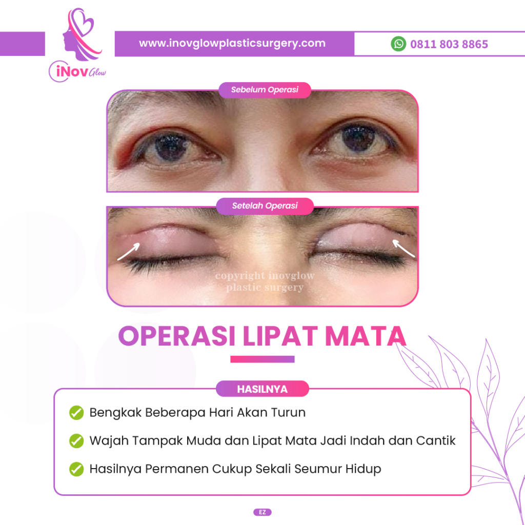 Mau Tampilan Area Mata Muda Maksimal? Pahami Keunggulan Duet Blefaroplasti & Brow Lift Di Sini! Hubungi Dr. Heri Noviana, Sp.BP-RE, M.Ked.Klin untuk konsultasi!