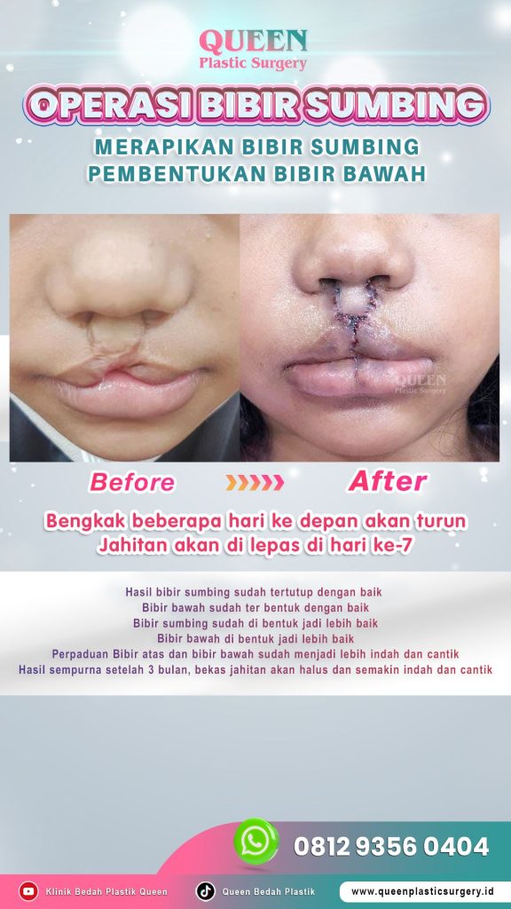 Bebas cemas demi masa depan si kecil! Intip langkah-langkah penanganan bibir sumbing di sini.