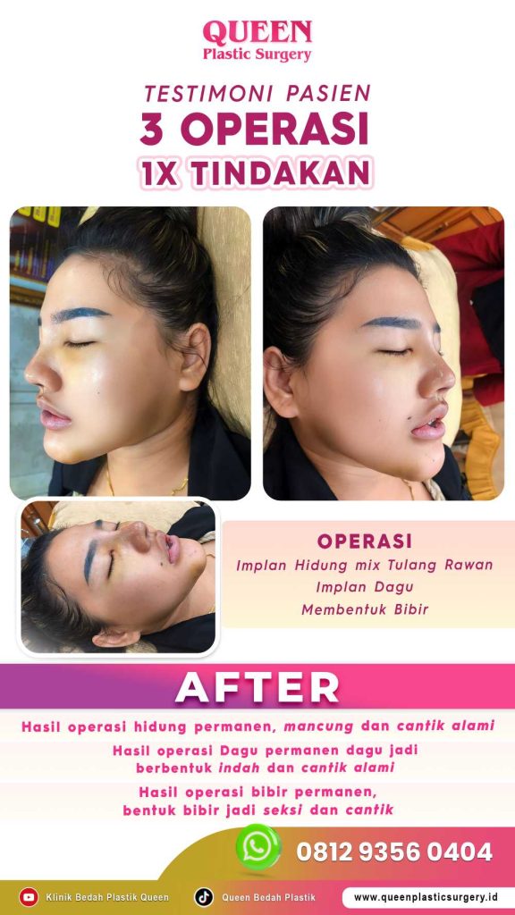 Takut operasi bibir sumbing menyisakan bekas mencolok? Simak penjelasan presisi dari spesialisnya!