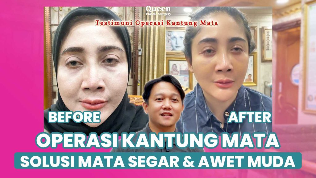 Wajah mendadak kelihatan 10 tahun lebih tua? Ketahui penyebab utama kantong mata kendur dan solusinya.