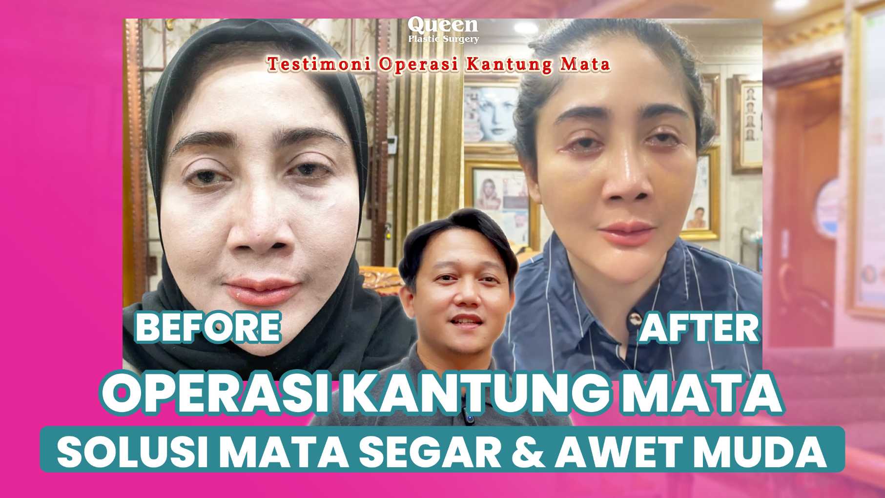 Wajah mendadak kelihatan 10 tahun lebih tua? Ketahui penyebab utama kantong mata kendur dan solusinya.