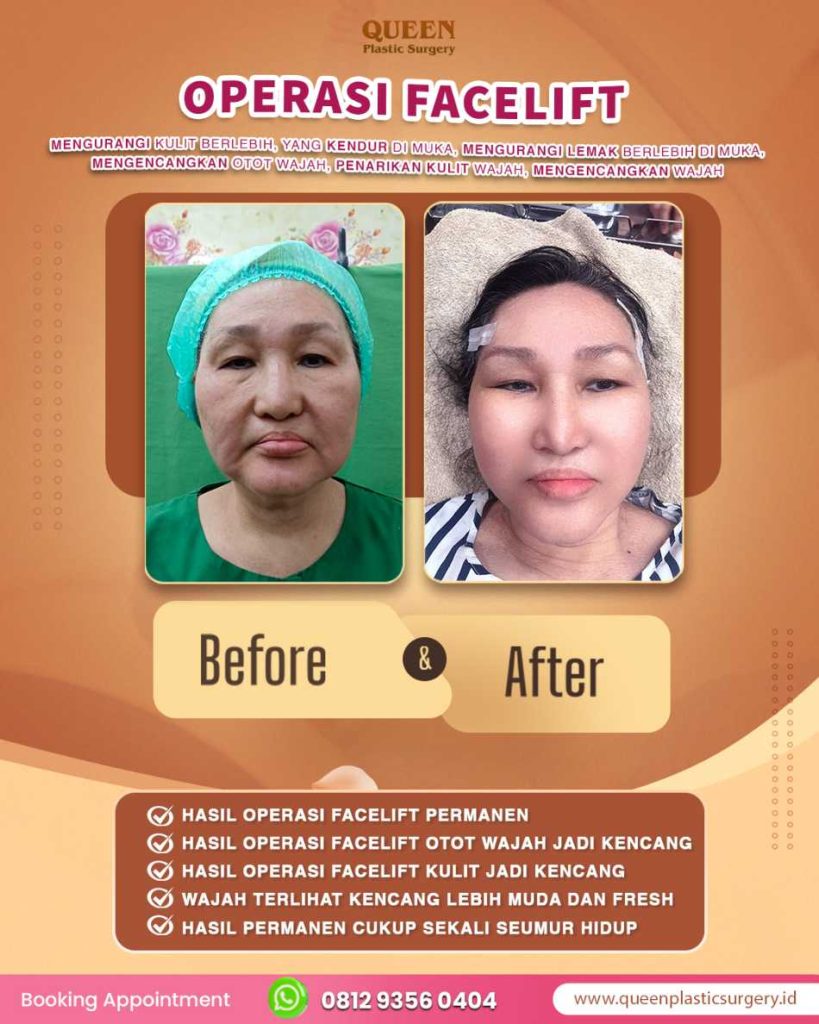 Bye-bye efek wajah ditarik kaku! Intip transformasi dan perkembangan teknik facelift modern terkini.