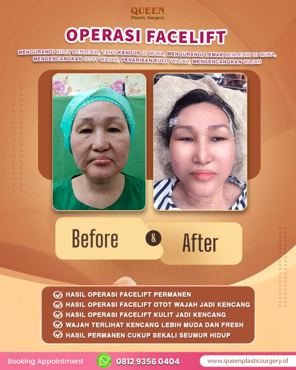 Bye-bye efek wajah ditarik kaku! Intip transformasi dan perkembangan teknik facelift modern terkini.