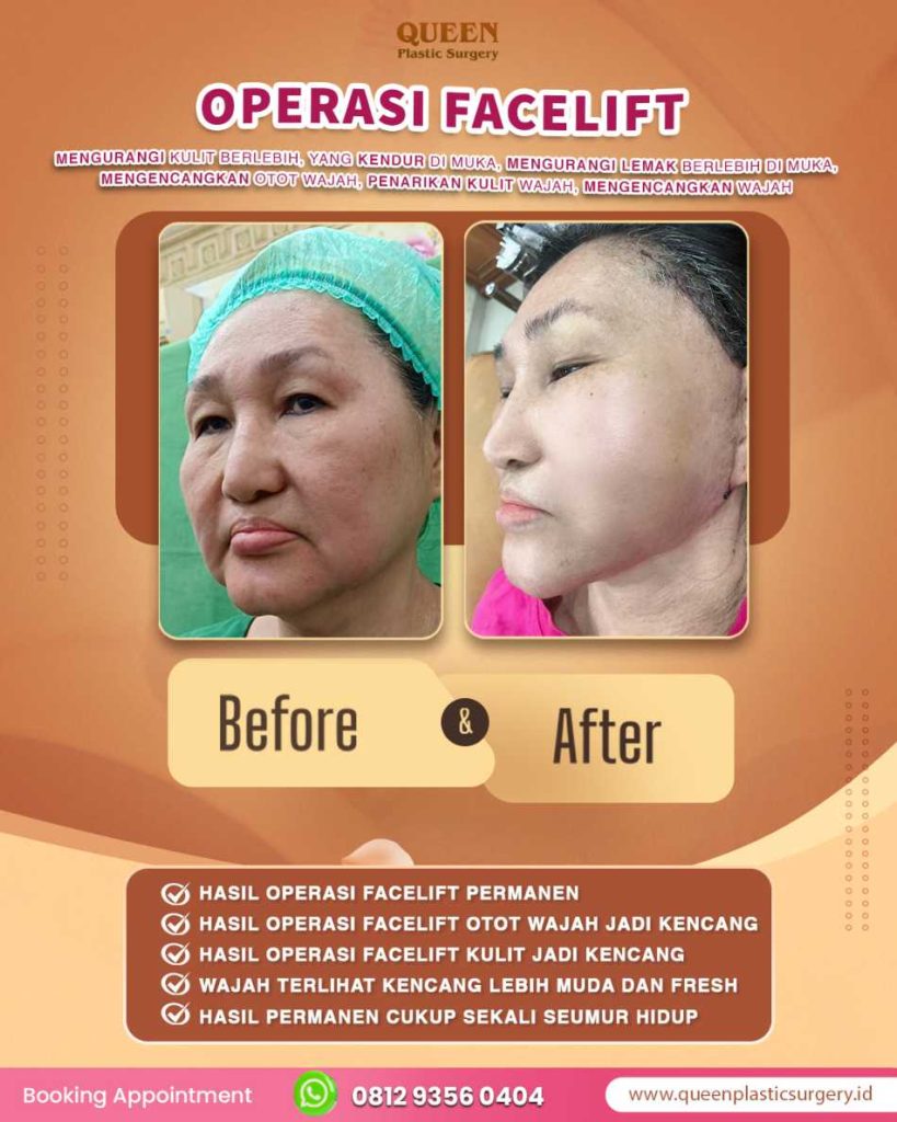 Mau tahu bagaimana facelift berkembang dari sekadar potong kulit jadi perbaikan struktur dalam? Simak!