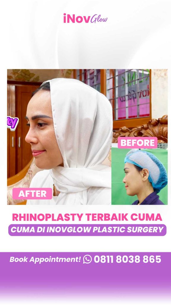 Bukan Sekadar Estetika! Ini Cara Rhinoplasty Memperbaiki Struktur Hidung & Fungsi Napas. Konsultasi awal dengan Dr. Heri Noviana di link ini!