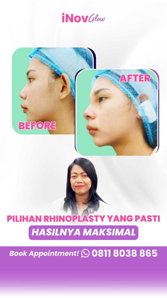 Sering Susah Napas Dan Bikin Gak Pede? Ini Satu Tindakan Medis untuk 2 Masalah Sekaligus! Klik di sini untuk konsultasi dengan Dr. Heri Noviana!