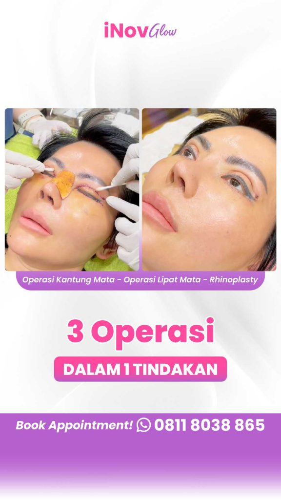 Kembalikan Kepercayaan Diri dan Keindahan Matamu Mulai Hari Ini! Pahami Solusi Operasi Revisi Blefaroplasti Sekarang. Hubungi tim Dr. Heri Noviana, Sp.BP-RE, M.Ked.Klin untuk jadwal sesi konsultasi!