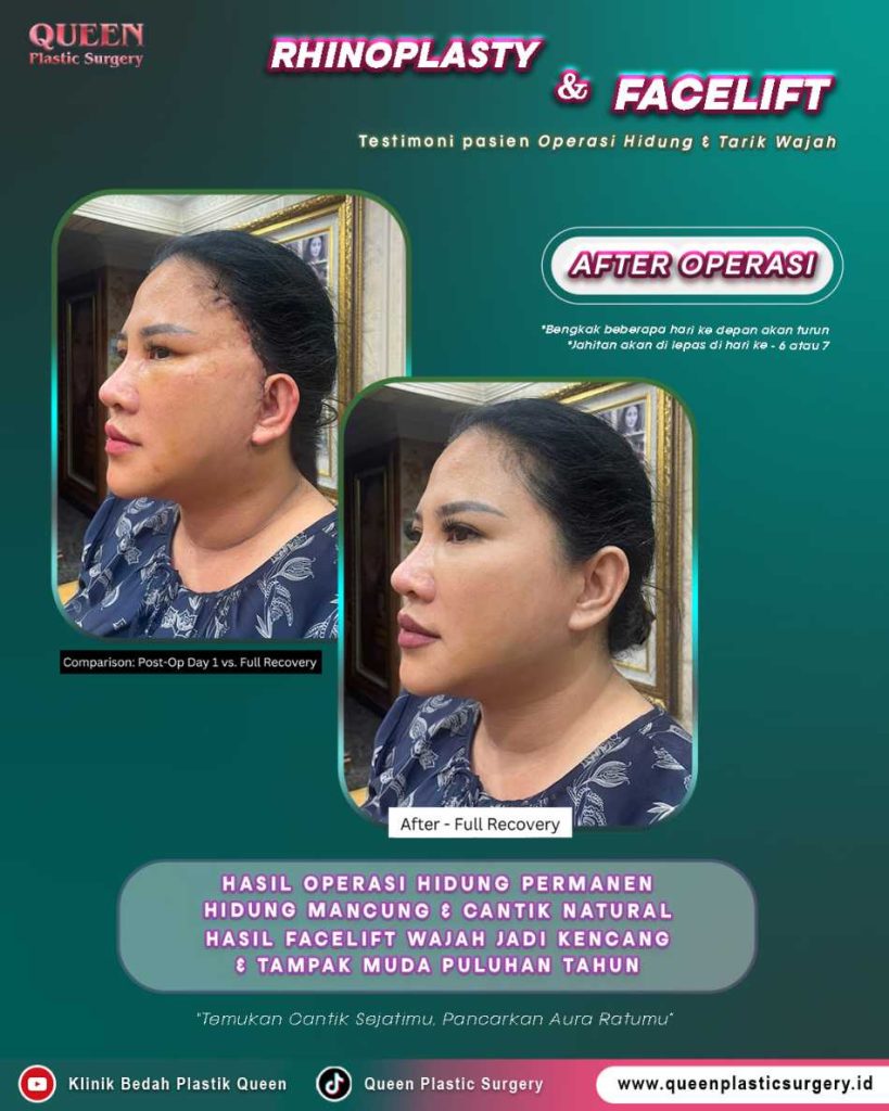 Stop percaya mitos lama operasi tarik wajah! Buka mata dengan fakta evolusi facelift modern ini.