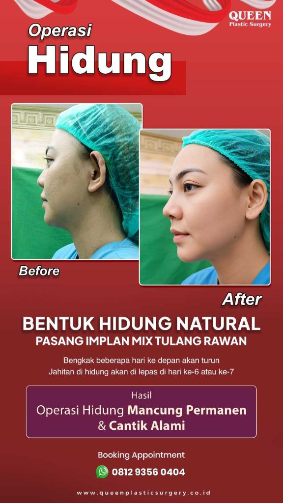 Bentuk hidung tirus, mancung, dan pas dengan proporsi wajah? Cek estimasi pemulihannya sekarang.