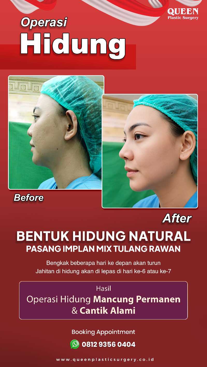 Bentuk hidung tirus, mancung, dan pas dengan proporsi wajah? Cek estimasi pemulihannya sekarang.