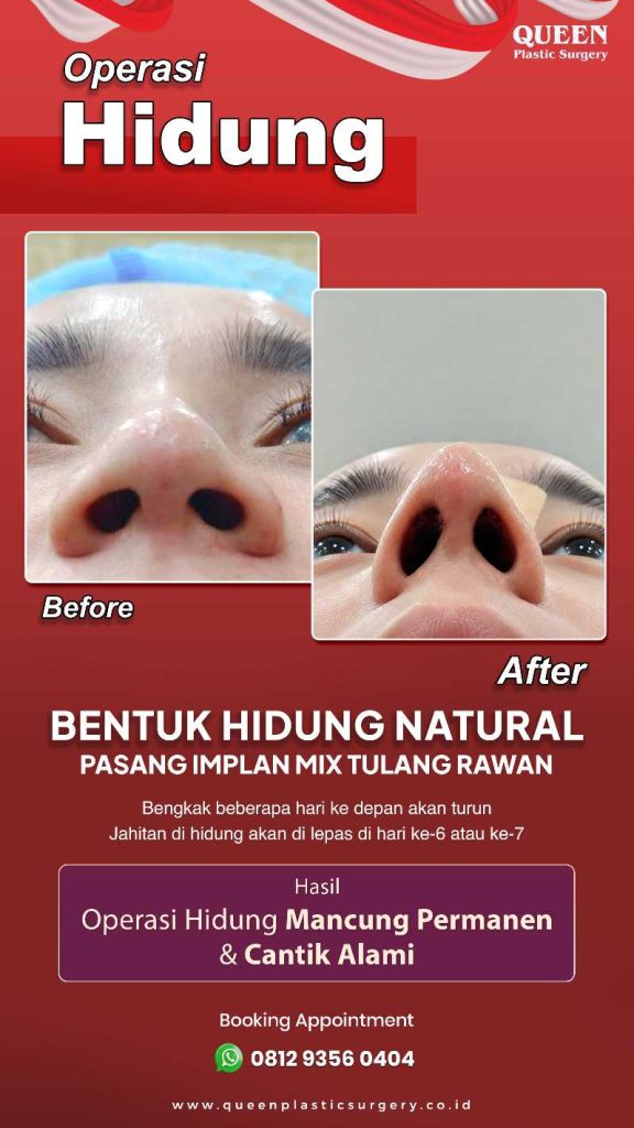 Fatal kalau asal ubah bentuk hidung! Ini alasan kenapa penyempurnaan hidung butuh presisi tinggi.