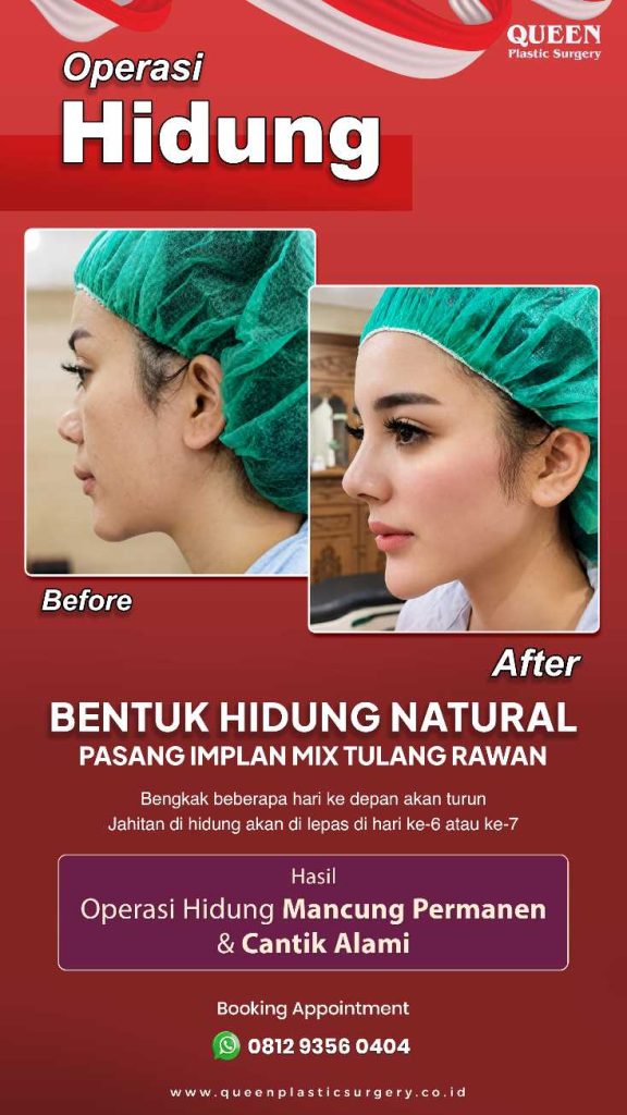 Rahasia batang hidung mancung, proporsional, dan natural terungkap! Cek faktanya sekarang.