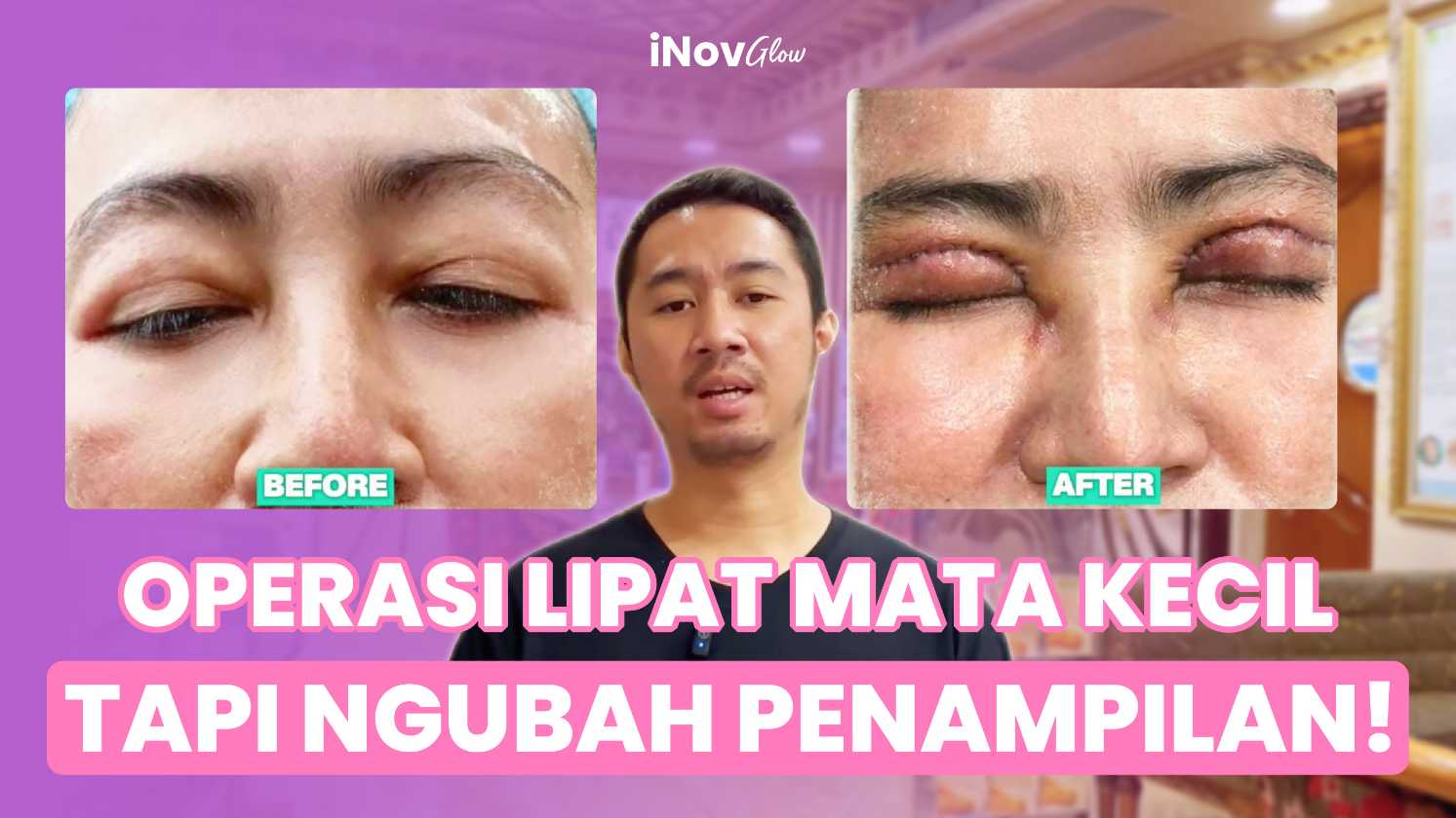 Rahasia Memperbaiki Lipatan Mata Kebesaran Terbongkar! Bagaimana Tingkat Keberhasilannya? Dapatkan jawabannya & konsultasi langsung dengan Dr. Heri Noviana!