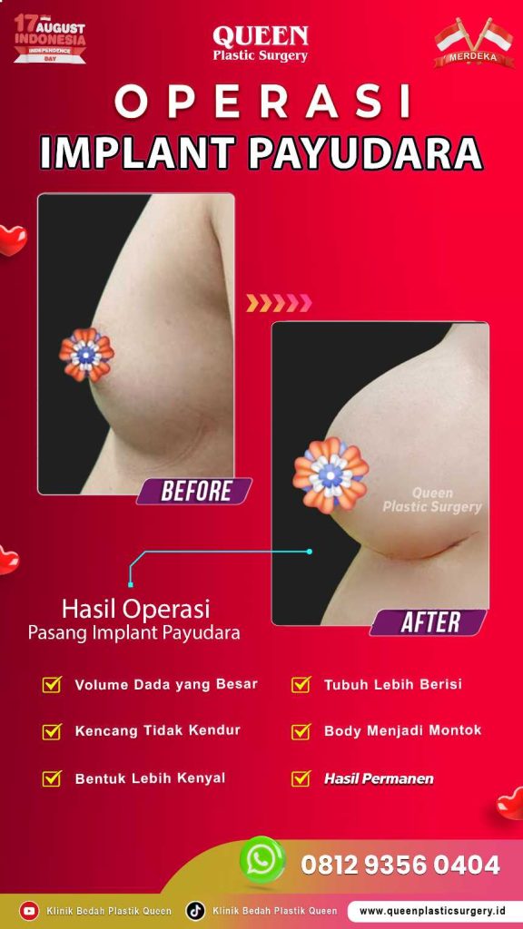 Stop bingung pilih bentuk implan! Simak perbandingan medis implan bulat vs teardrop sekarang.