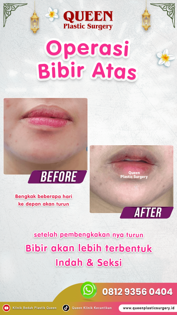 Mau tahu bagaimana teknik bedah plastik mengembalikan bentuk bibir seperti semula? Simak di sini!