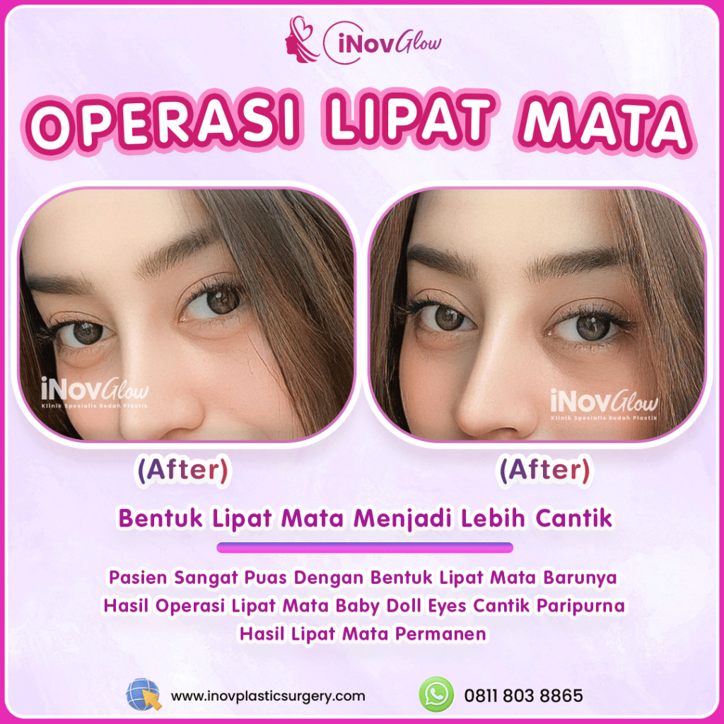 Jangan Cuma Potong Kelopak Mata! Bongkar Alasan Kenapa Blefaroplasti Harus Di-Kombinasi Brow Lift! Tanya Dr. Heri Noviana sekarang!