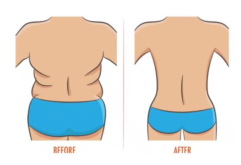 Lemak punggung membandel bikin lipatan baju kelihatan? Ini rahasia siluet mulus dan proporsional seketika dengan liposuction punggung!