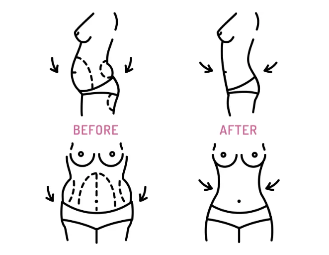 Anggap liposuction buat kurusin badan? Salah besar! Ini fungsi sebenarnya yang wajib kamu tahu.