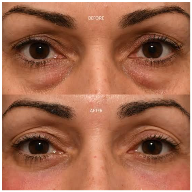 Bikin wajah tampak tua dan kuyu? Intip trik membuang lemak kantung mata secara presisi dengan blepharoplasty!