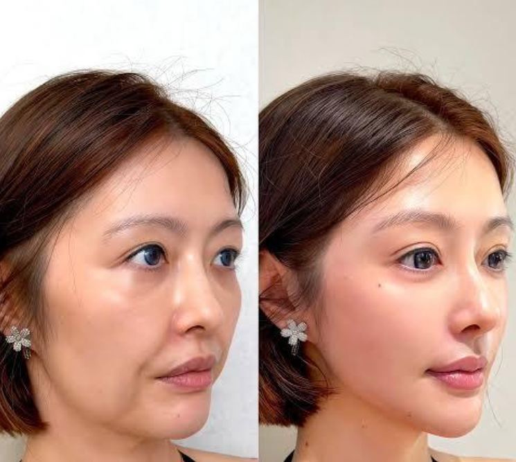 Wajah kendur dan kerutan membandel hilang seketika? Intip transformasi luar biasa pasca-facelift!