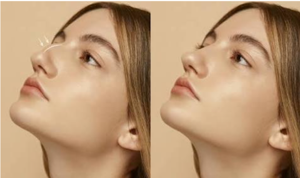 Jangan pernah pasrah dengan bentuk hidungmu! Intip trik medis bikin profil wajah makin proporsional.